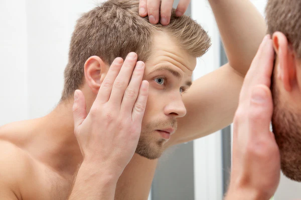 Male Pattern Baldness